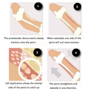 Proextender Penis Enlargement Device For Male
